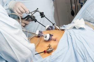 Photo of stomach surgery 