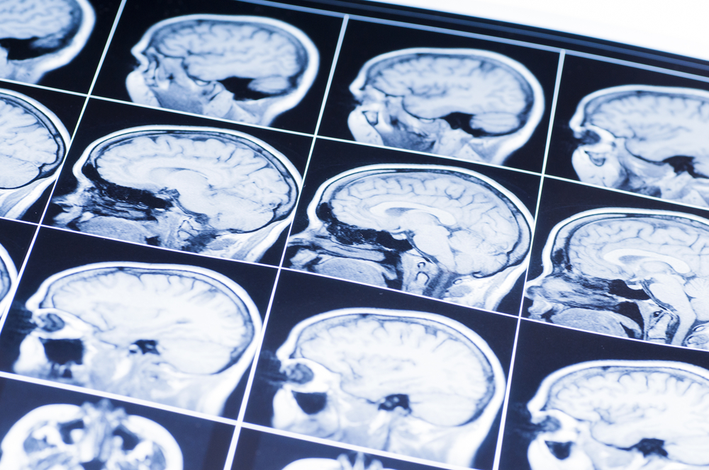 brain scans TBI