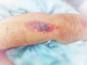 New York Nursing Home Abuse Lawyers for Bedsores or Pressure Ulcers